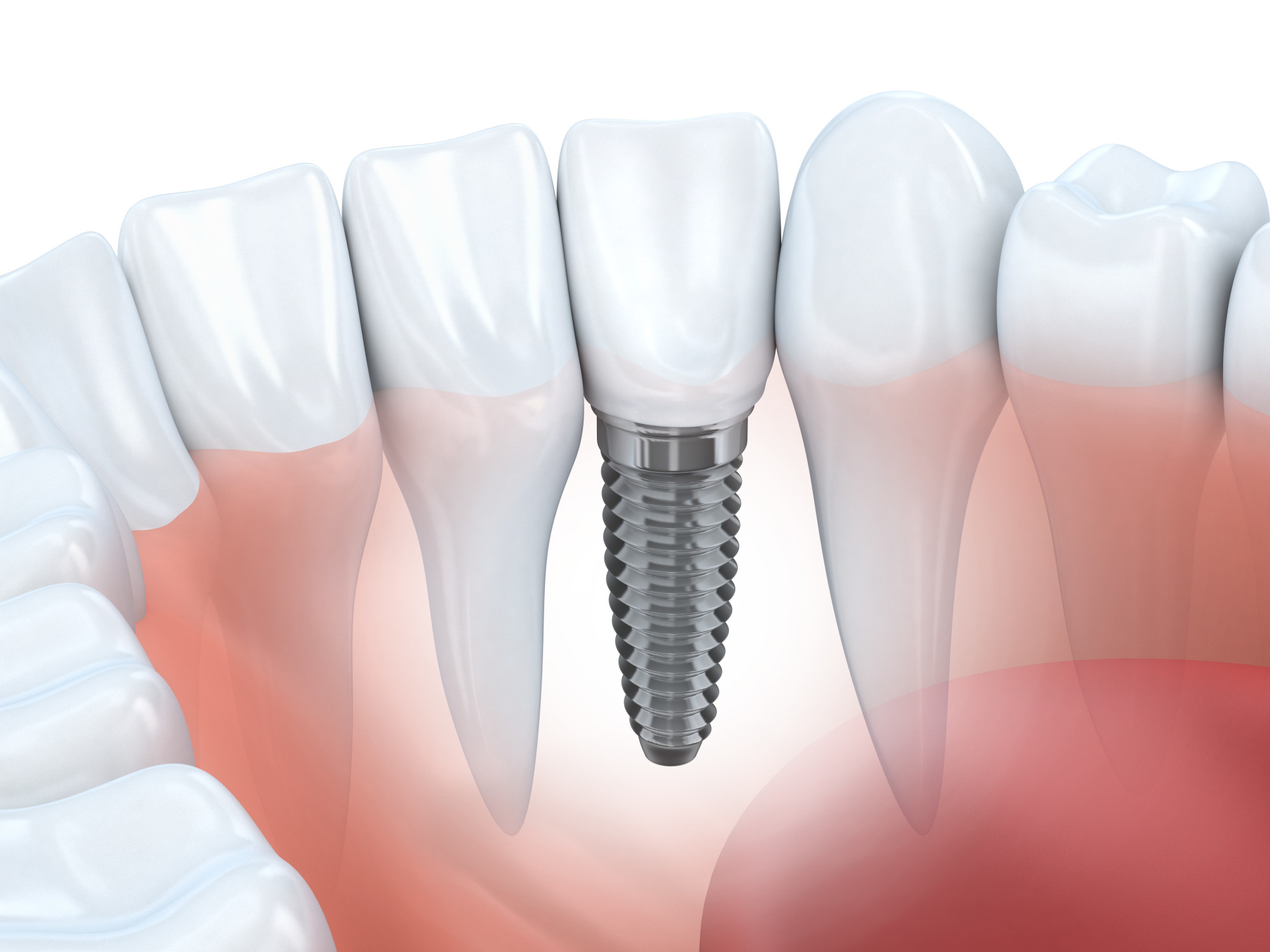 loose root canal crown